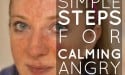 3 Simple Steps For Calming Angry Skin (1)