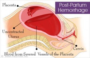 Postpartum Hemorrhage: The Postpartum Experience I Wasn'T Prepared For 3 Daily Mom, Magazine For Families