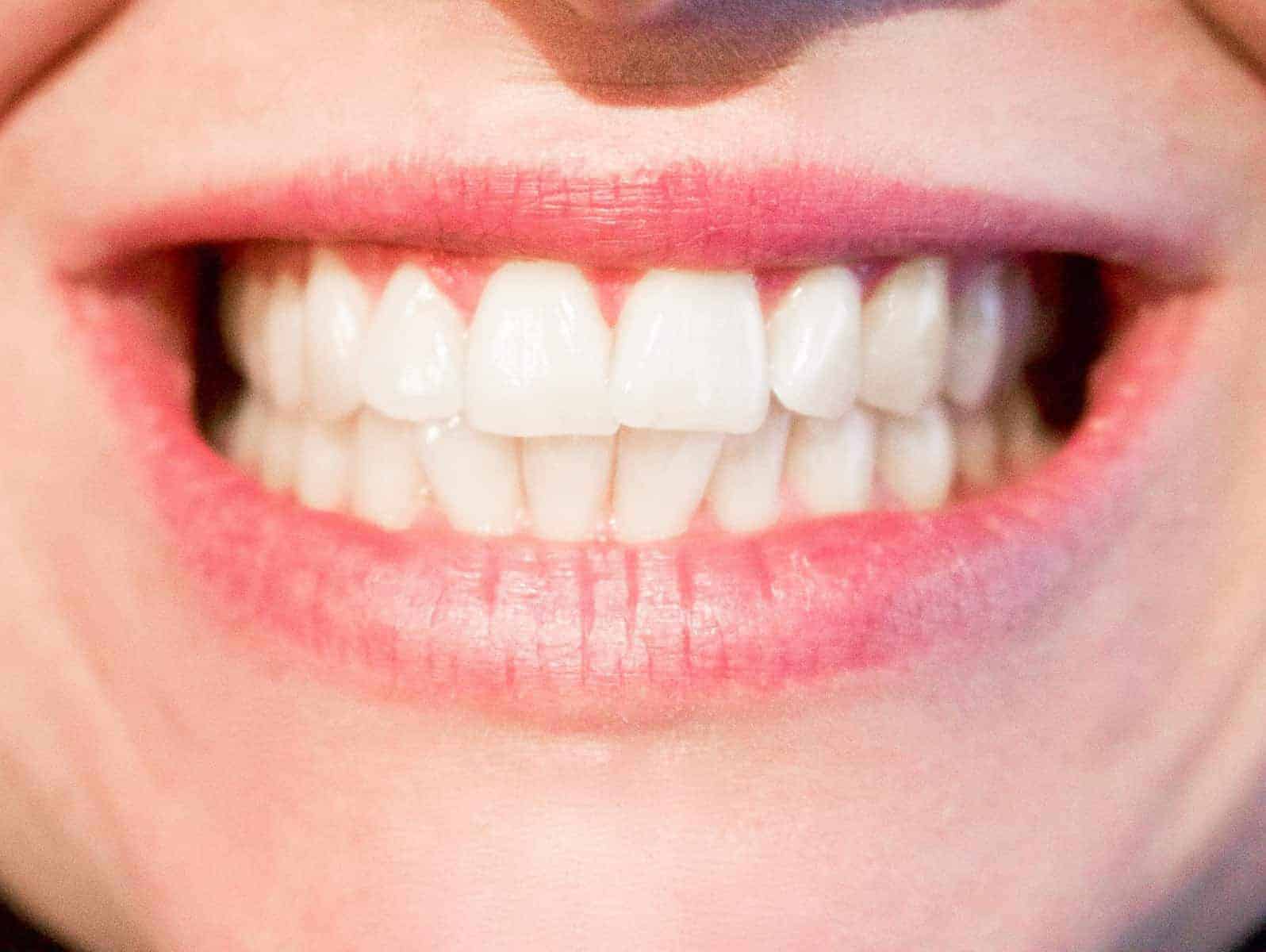 Some Obvious And Not-so-obvious Diet Tips To Keep Your Teeth Healthy