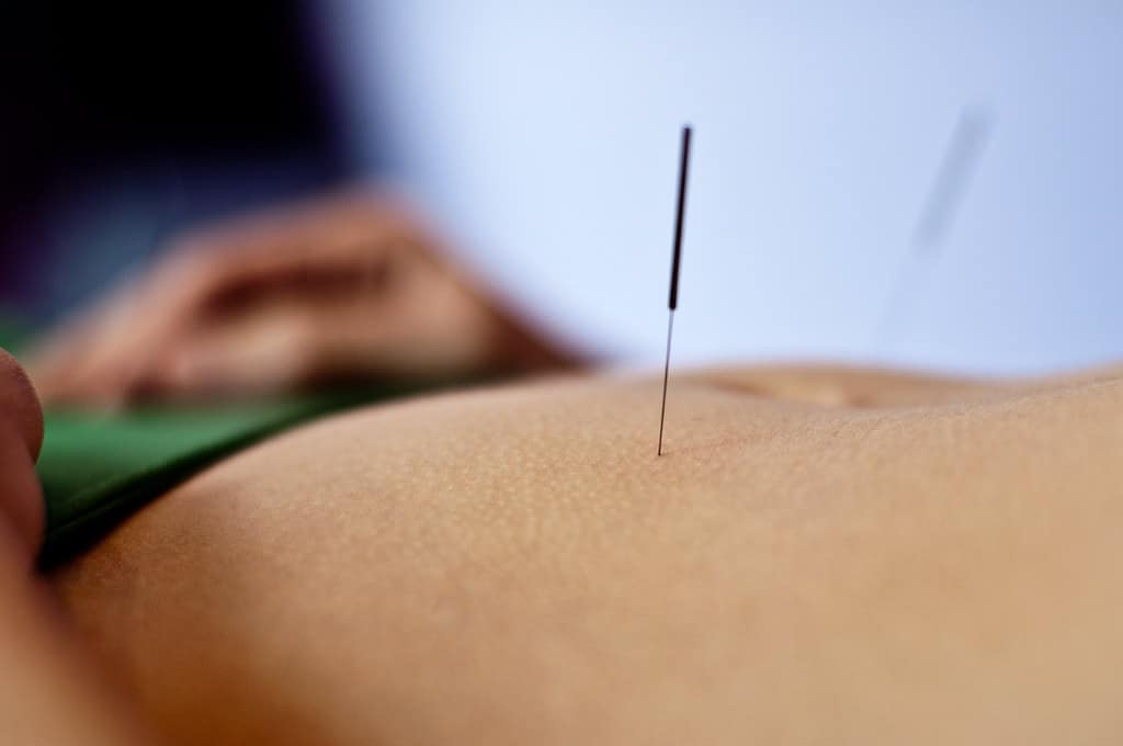 Acupuncture And Fertility: What You Need To Know
