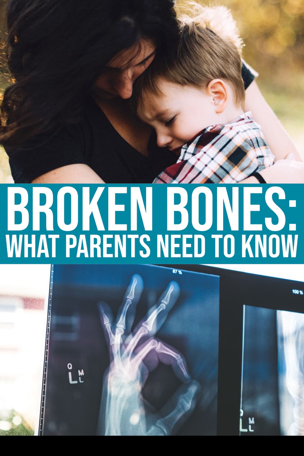 Broken Bones: A Comprehensive List Of What You Need To Know As A Parent