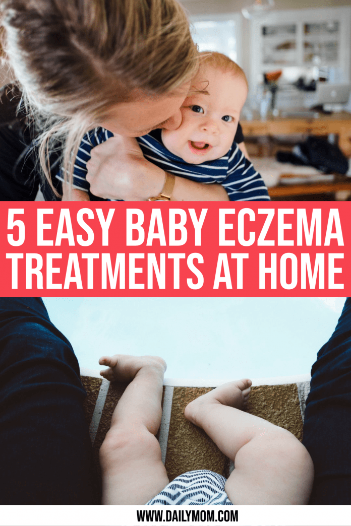 5 Easy Baby Eczema Treatment Options To Try At Home