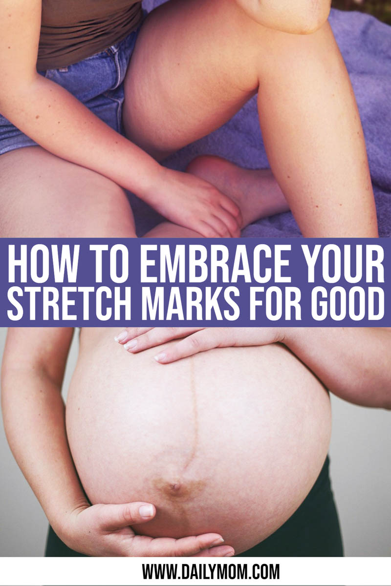 Stretch Marks: Normalizing And Embracing Your Beautiful Body This Year