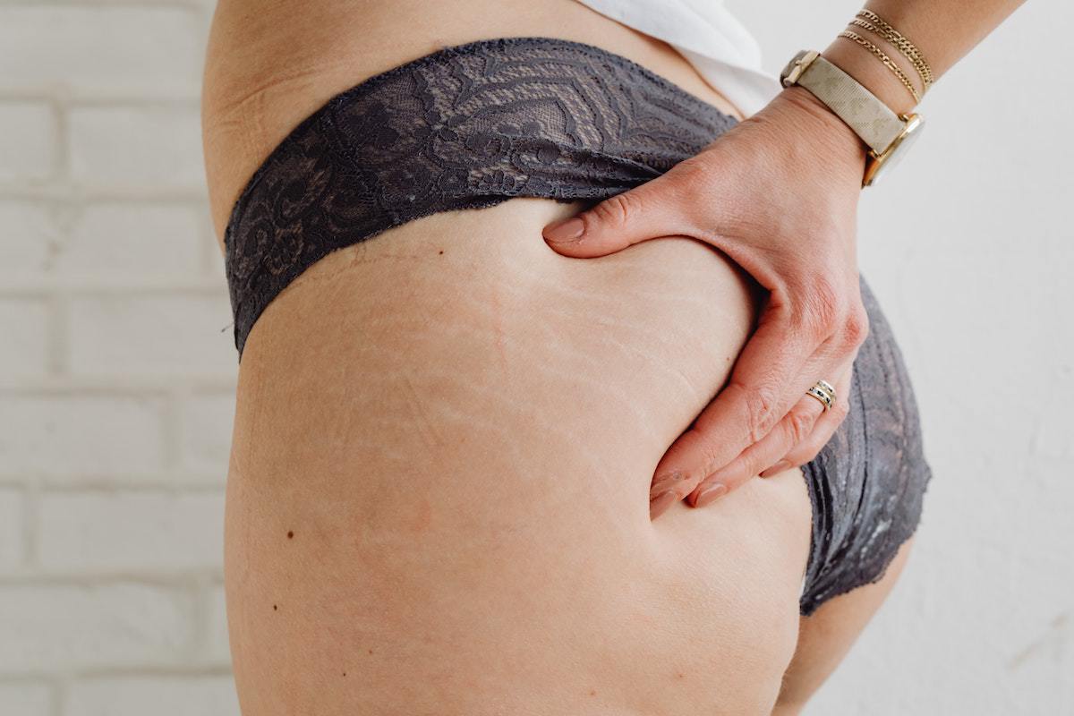 Stretch Marks: Normalizing And Embracing Your Beautiful Body This Year