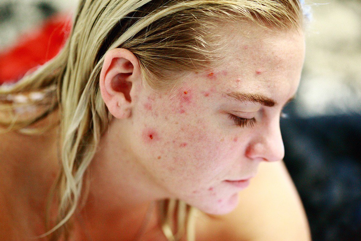 17 Of The Best Skincare Products For Acne: Facial Treatments Right At Home