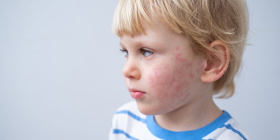 The Rarest and Most Uncommon Food Allergies in Kids: Understanding Rare Allergies, Allergic Reactions, and Symptoms 2 Daily Mom, Magazine for Families Daily Mom Parent Portal Rare Allergies