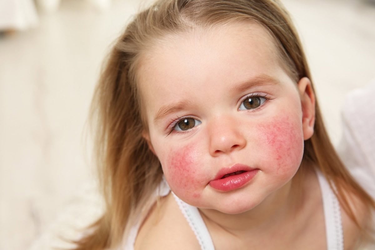The Rarest and Most Uncommon Food Allergies in Kids: Understanding Rare Allergies, Allergic Reactions, and Symptoms 4 Daily Mom, Magazine for Families Daily Mom Parent Portal Rare Allergies