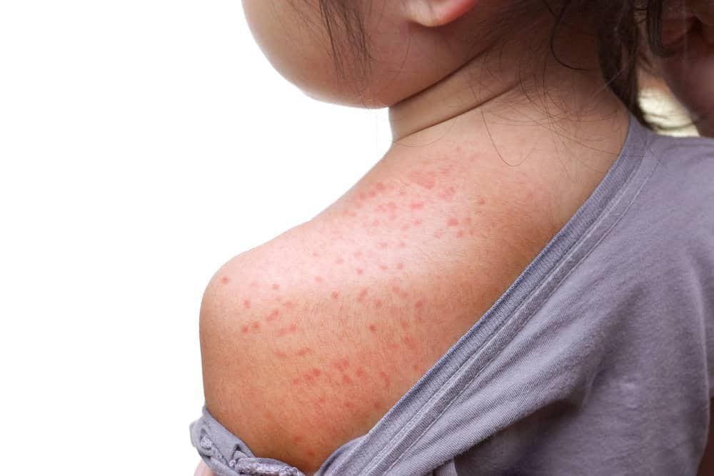 The Rarest and Most Uncommon Food Allergies in Kids: Understanding Rare Allergies, Allergic Reactions, and Symptoms 3 Daily Mom, Magazine for Families Daily Mom Parent Portal Rare Allergies