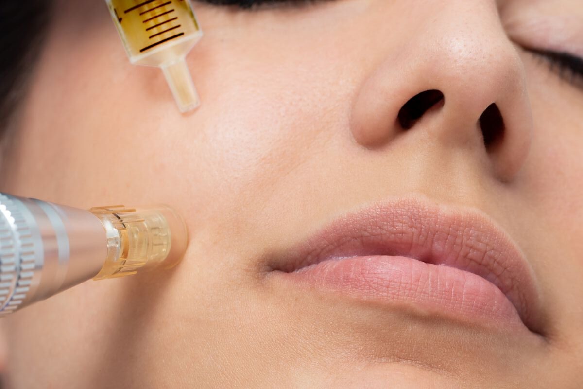 Micro Needling While Pregnant: What Skin Treatments Are Pregnancy Safe &Amp; Can You Get Skin Needling During Pregnancy 3 Daily Mom, Magazine For Families